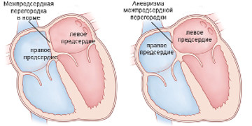 anevrizma serdca