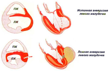 anevrizma serdca1