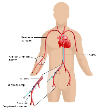 angiografija2