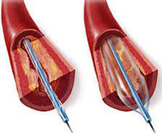 angioplastika serdca