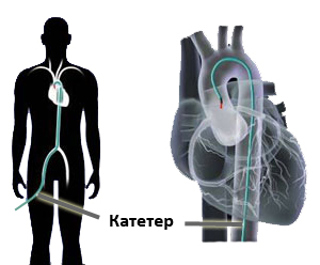 angioplastika serdca1