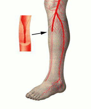 ateroskleroz konechnostej obliterirujushij