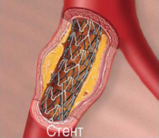 ateroskleroz stenozirujushij2