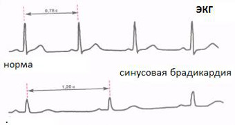bradikardija1
