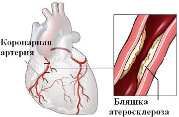 hronicheskaja ibs2