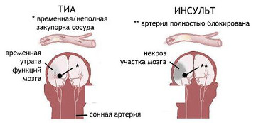 ishemicheskaja ataka