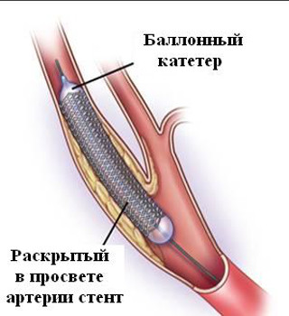 ishemicheskij infarkt2