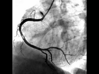 koronarografija i stentirovanije1
