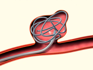 lechenije anevrizm1