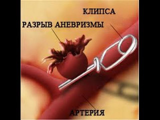lechenije anevrizm2