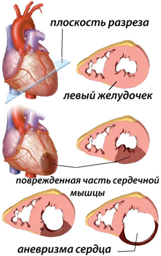 lechenije anevrizmi serdca