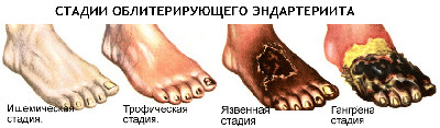 obliterirujushij endarteriit