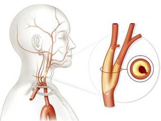 okkluzija sonnoj arterii