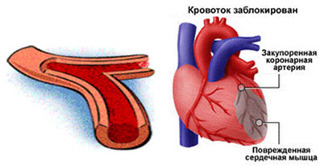rannjaja postinfatktnaja stenokardija2