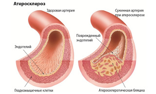 simptomy boleznej sosudov