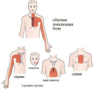 simptomy stenokardii