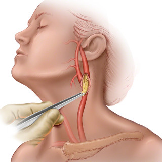 stenoz sonnoj arterii2