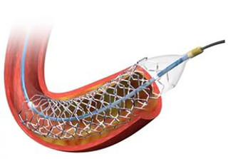 stent2