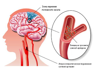 stentirovanie sonnyh arterij