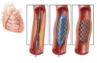 stoimost koronarnih stentov