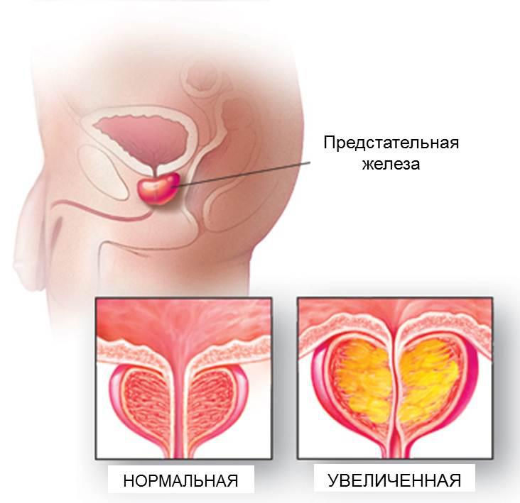 Предстательная железа