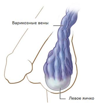 varikoznue venu urologiya