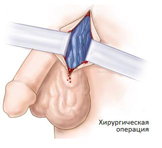xiryrgicheskoe lechenie varikocelle