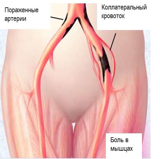 zabolevaniya perefericheskix arteri