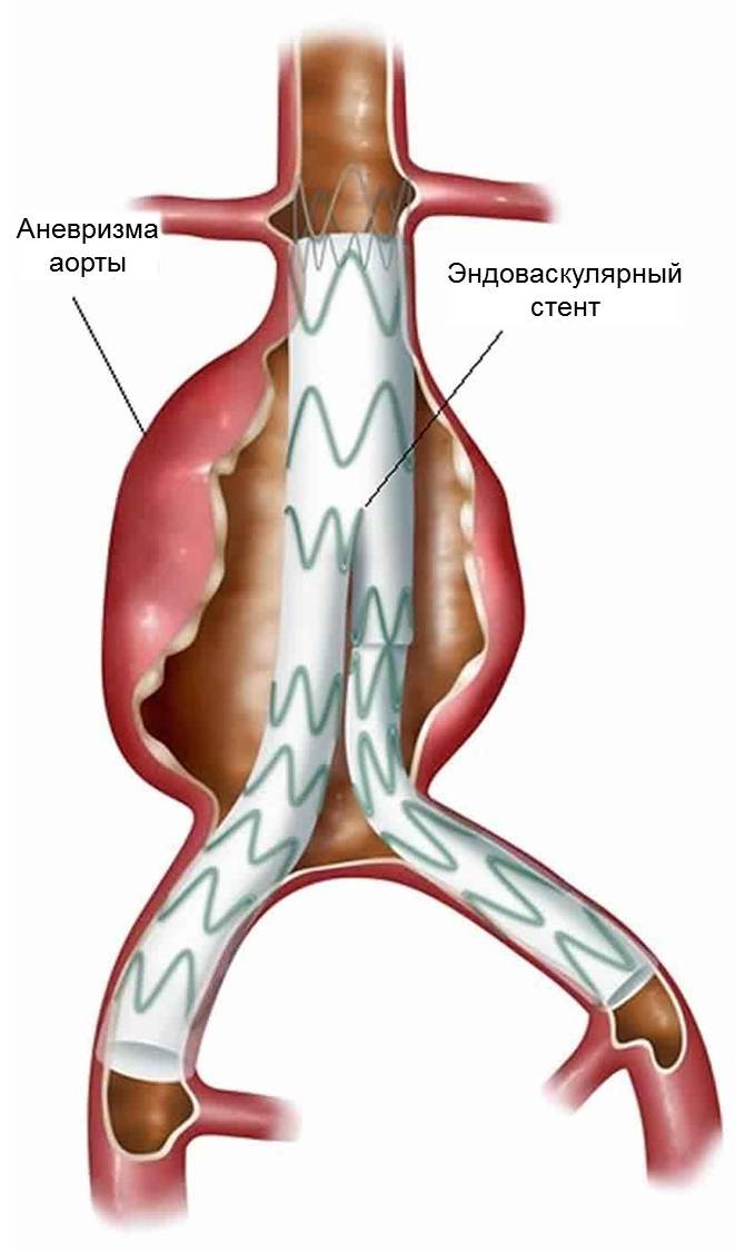 аневризма2