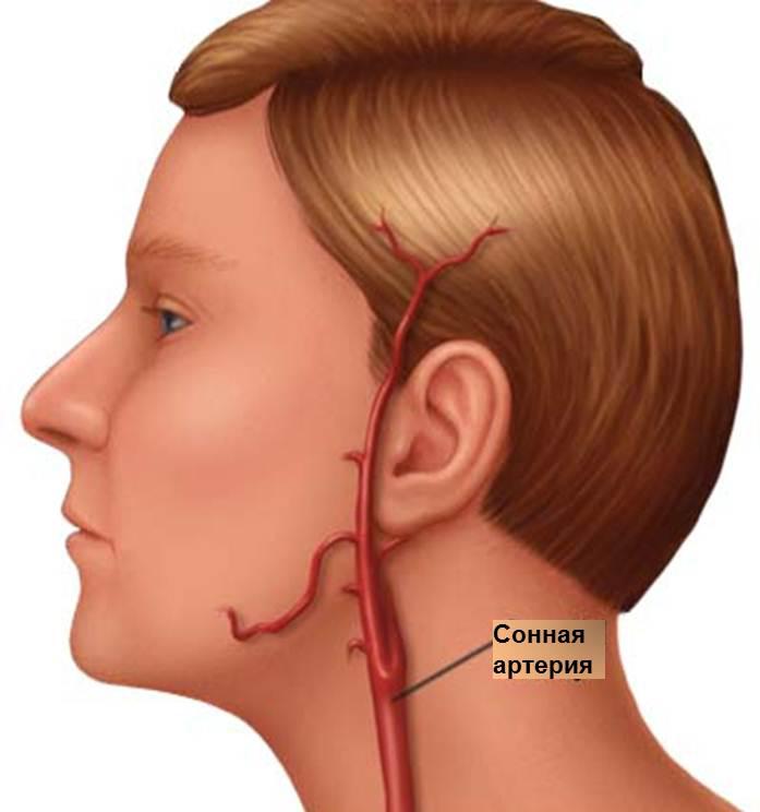 заболевание сонной артерии