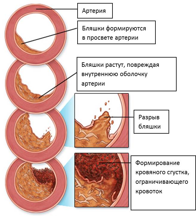 заболевания кардиология Атеросклероз