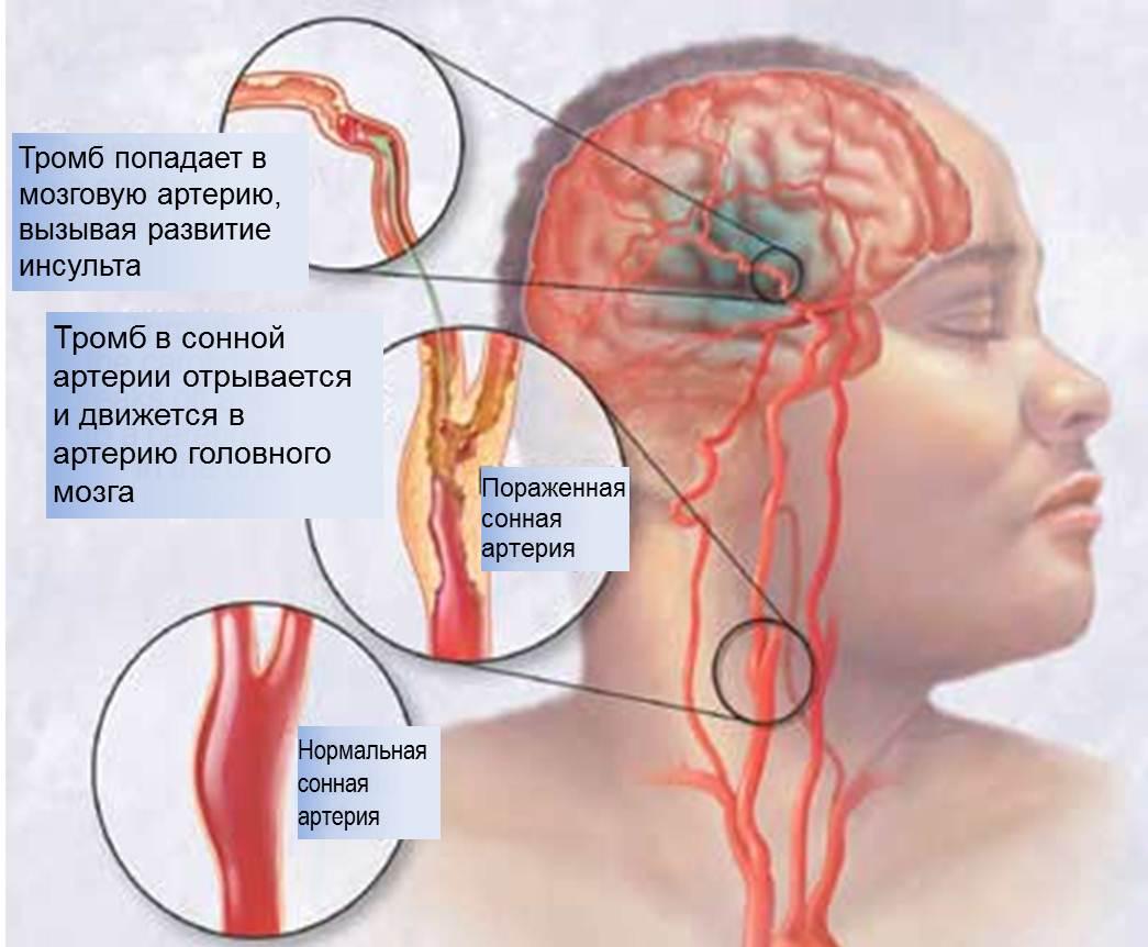 осложнения при заболевании сонной артерии
