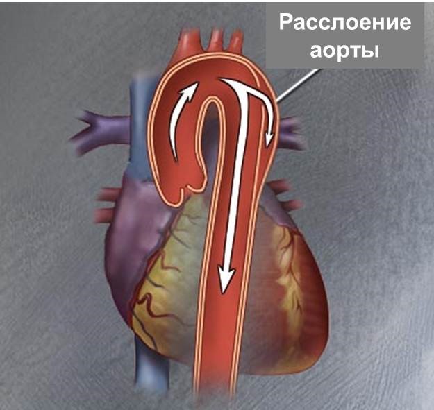 расслоение-аорты